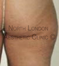 Endermologie after Picture